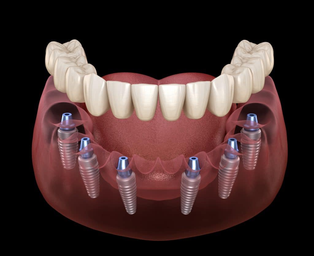 Oral Surgery & Implantology
